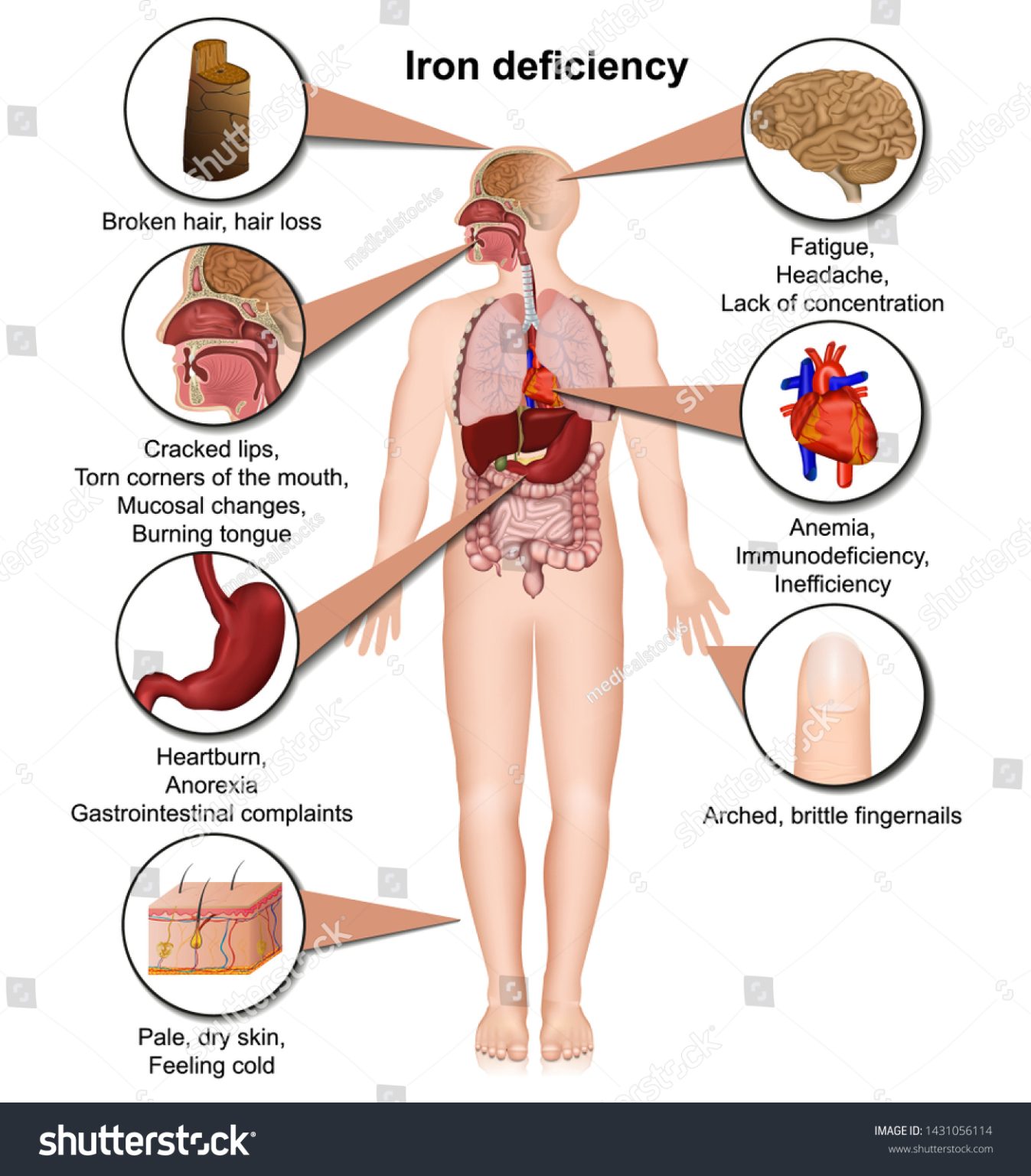 side-effects-of-low-iron-side-effects-guru