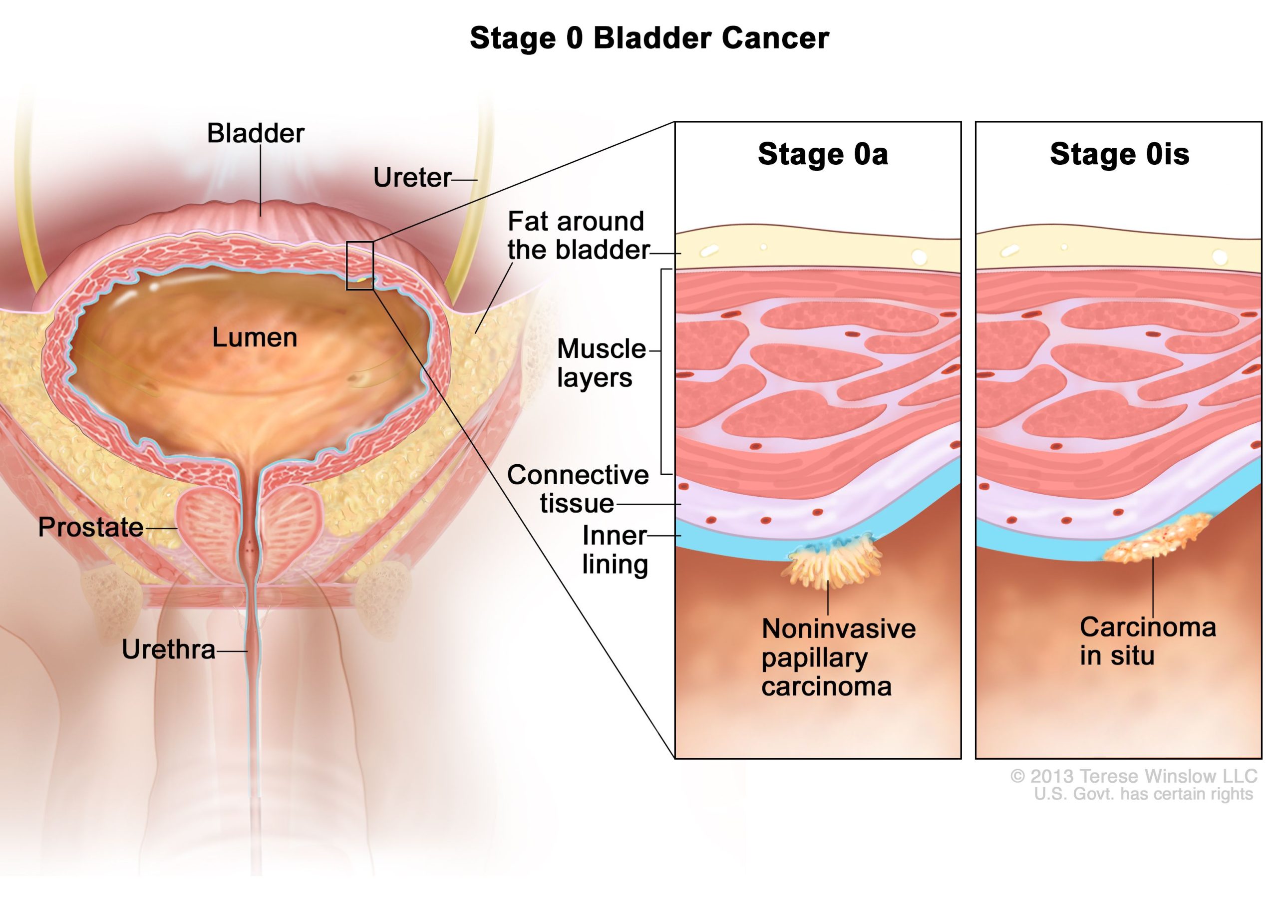 Bladder Chemotherapy Side Effects