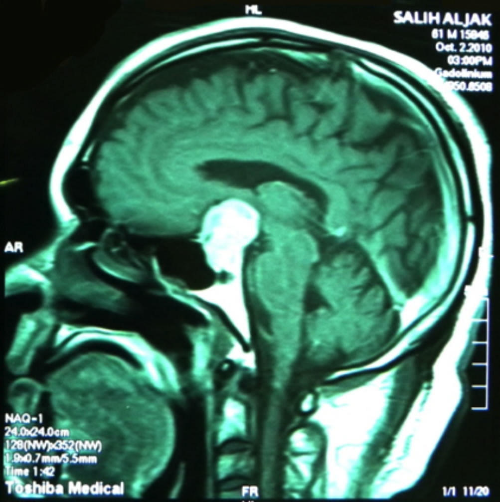 Mri Side Effects Eyes