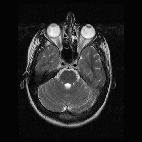 Major Side⁣ Effects​ of MRI on Eyes