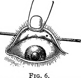 Side Effects of Castor Oil on Eyelashes