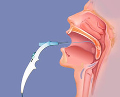 Remedies ⁢for Palatal⁢ Expander Side ‍Effects ‌on Nose